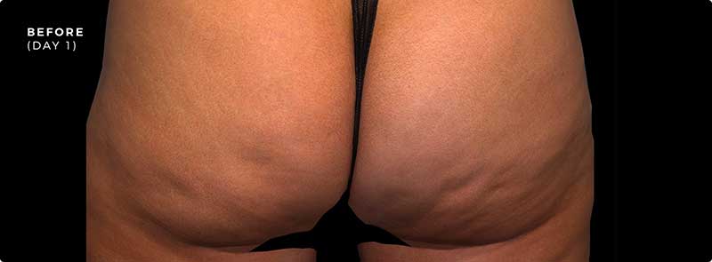 qwo cellulite treatment soho nyc